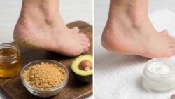 Quick Ways to Heal Dry Cracked Heels at Home Using Safe and Effective Kitchen Ingredients